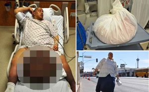 Pria dengan Testis Seberat 45 Kg Berhasil Dioperasi